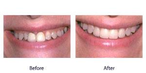 Before and After Before and After