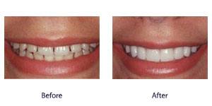 Before and After Before and After