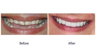 Before and After Before and After